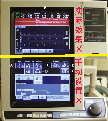 绝对实用的呼吸机入门系列(二)重要参数设置及a/c模式